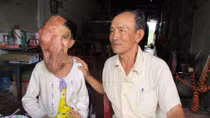 Nghị lực của cô bé bán vé số có khuôn mặt 'không dám nhìn'