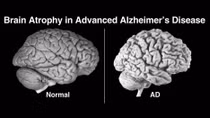 Bệnh Alzheimer lây truyền qua máu?