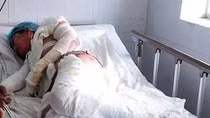 Người vợ bị chồng đốt đã qua đời