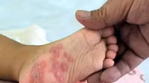 61 tỉnh, thành đều có trẻ bị tay-chân-miệng 