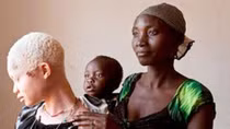 Nạn săn người bạch tạng "tăng nhiệt" ở Malawi