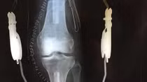 Ca cấy ghép đầu gối thành công đầu tiên trên thế giới