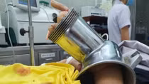 Người phụ nữ nhập viện với chiếc máy xay thịt "ngoạm" hết bàn tay