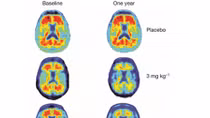 Thuốc mới Aducanumab hứa hẹn chữa khỏi bệnh Alzheimer
