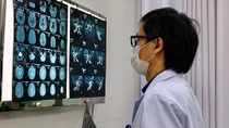 Phình động mạch não - Không thể coi thường