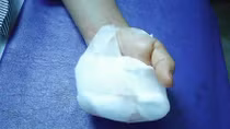 Người phụ nữ bị máy xay thịt nghiền nát 4 ngón tay