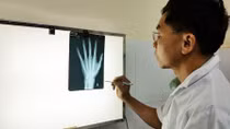 Xác định tuổi qua giám định xương: Nút thắt những vụ án