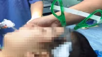 Bé gái bị bạn dùng kéo đâm xuyên hộp sọ