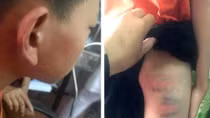 Mẹ kế bạo hành khiến một học sinh lớp 6… nhập viện cấp cứu (?)
