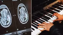 Bệnh nhân vừa chơi piano vừa được phẫu thuật u não