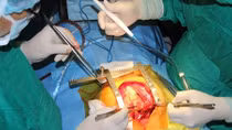 Lấy viên đạn ra khỏi tim một cựu chiến binh bị thương cách đây gần 40 năm