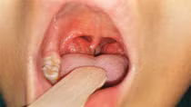 Một HS được điều trị cách ly do nghi mắc bệnh bạch hầu
