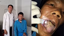 Phẫu thuật thành công ung thư lưỡi bằng vi phẫu tạo hình