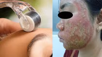 Tai biến do làm đẹp bằng phương pháp lăn kim