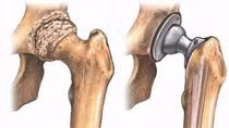 Thay khớp háng nhân tạo thành công cho bệnh nhân 100 tuổi