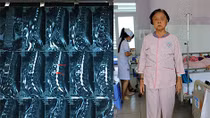 Cụ bà 69 tuổi thoát cảnh liệt giường nhờ kỹ thuật “đổ” xi măng cột sống