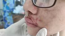 Mặt sưng phù, mưng mủ do tiêm filler làm đầy rãnh má