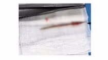 Bác sĩ sửng sốt khi phát hiện cây tăm chui vào tim một người đàn ông