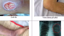 Nhiễm khuẩn cấp do bệnh Whitmore có thể gây mất mạng trong 1 tuần 