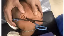 Cấp cứu kịp thời bệnh nhi 3 tuổi bị kéo đâm ngập lỗ tai