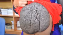 Bé gái 10 tuổi mang căn bệnh "mai rùa" kì dị của thế giới