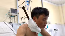 Cứu sống công nhân bị thanh sắt đâm xuyên từ cổ xuống ngực