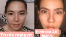 Hỏng mí mắt vì quá tin thẩm mỹ viện mang danh Quốc tế