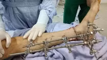 Những tai nạn kinh hoàng từ máy cắt cỏ