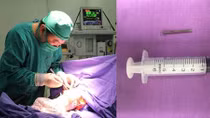 {HY HỮU} Một em bé nuốt phải chiếc đinh sắt dài 3cm