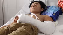 Một thanh niên bị quạt hút lúa chém nát cánh tay