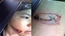 Bé gái bị bạo hành bằng sắt nung đỏ dí vào hai cánh tay