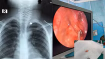 Bé trai suýt mất mạng vì bố bất cẩn trong sử dụng súng 