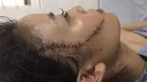 Dùng dao rạch mặt người tình để "thỏa cơn ghen"