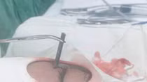 Cứu sống bệnh nhân bị đinh 3cm đâm vào mắt
