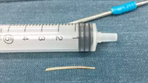 Chiếc xương cá 3cm nằm trong cổ bé gái gần nửa năm