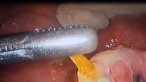 Người đàn ông bị xương cá đâm thủng ruột non