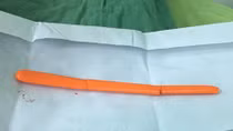 Cứu sống bệnh nhân tự lấy muỗng đâm vào hốc mắt xuyên sọ