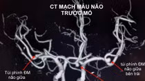 Bệnh nhân có 3 túi phình mạch máu não đã vỡ được cứu sống