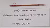 Tăm xỉa răng dài 6cm đâm thủng thành bụng 