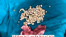 Bị hoại tử túi mật vì 241 viên sỏi 