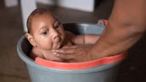 Một em bé ở Đắk Lắk nghi mắc chứng đầu nhỏ do Zika