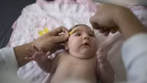Trẻ mắc chứng đầu nhỏ do virus Zika đầu tiên ở Việt Nam