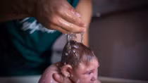 Số người mắc bệnh do virus Zika tăng nhanh