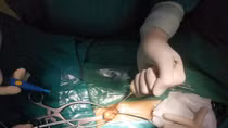 Bệnh viện Xanh Pôn cứu sống cháu bé bị bệnh nguy hiểm
