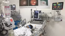 (Hy hữu) Nhổ răng sâu, răng văng vào phế quản phải đi cấp cứu