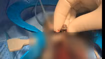 Hy hữu: Bị bạn nhậu nhét đinh vít dài 6cm vào niệu đạo 