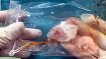 Ổ sán khủng trong não người đàn ông hay ăn tiết canh
