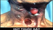 Hút thuốc lá, phá hủy đường hô hấp, rước bệnh ung thư