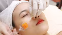 Làm đẹp “lăn kim” xong phải nhập viện gấp