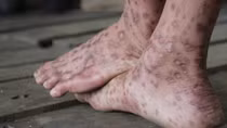 “Bệnh lạ” tái phát ở huyện miền núi Sơn Hà